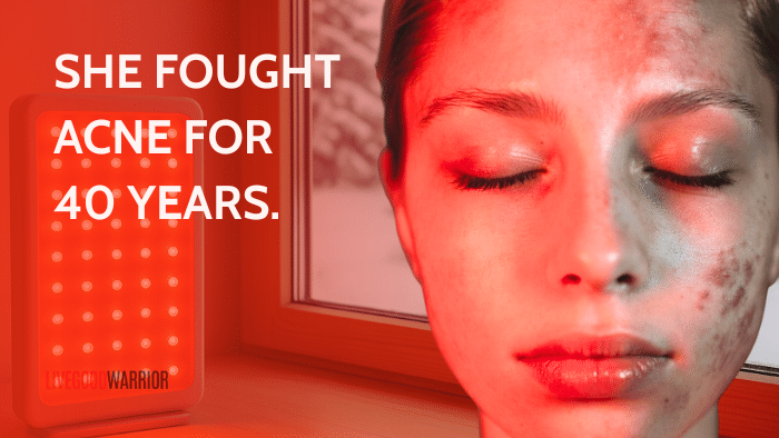 a woman benefiting from red light therapy for acne outbreak on her face